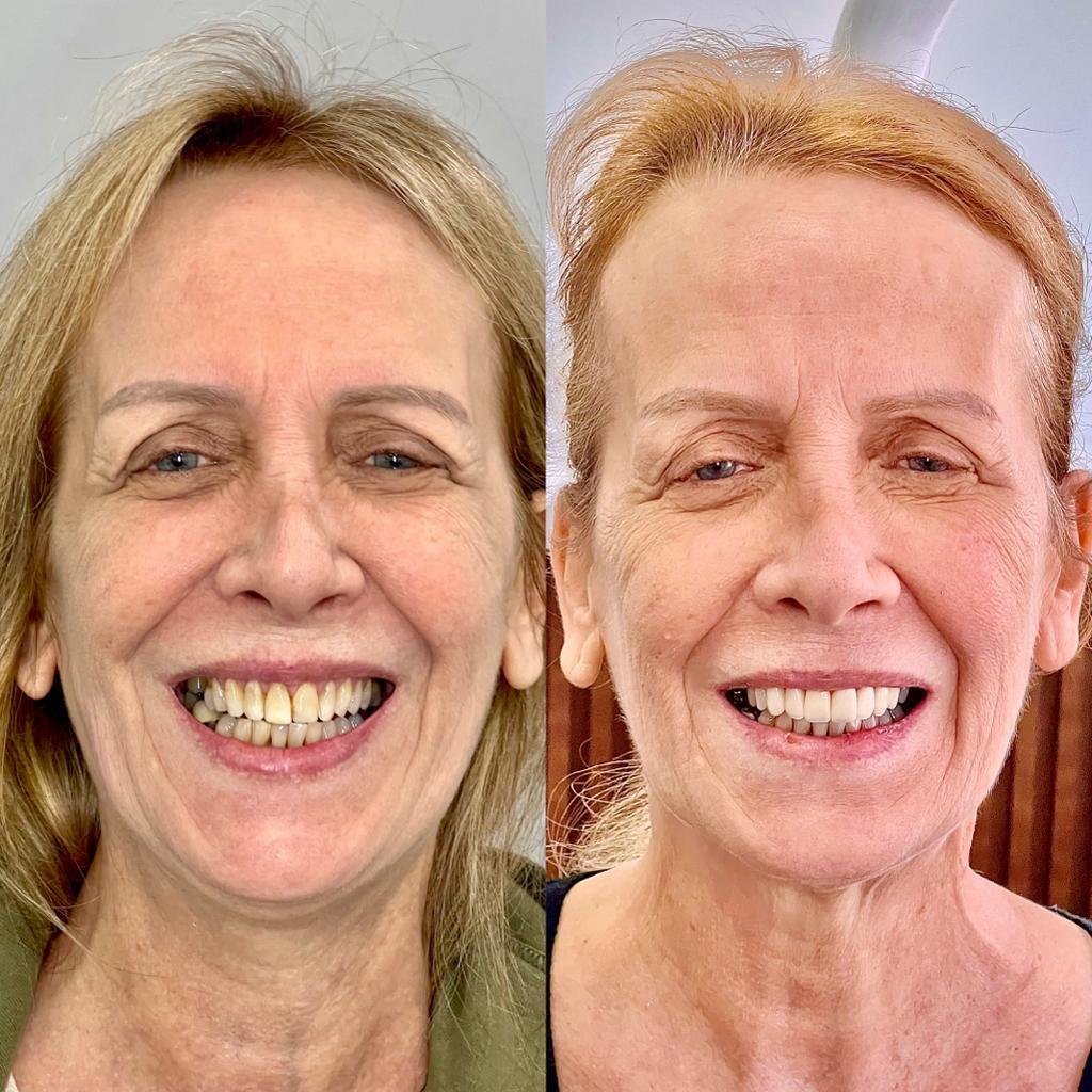 Antes X Depois 2