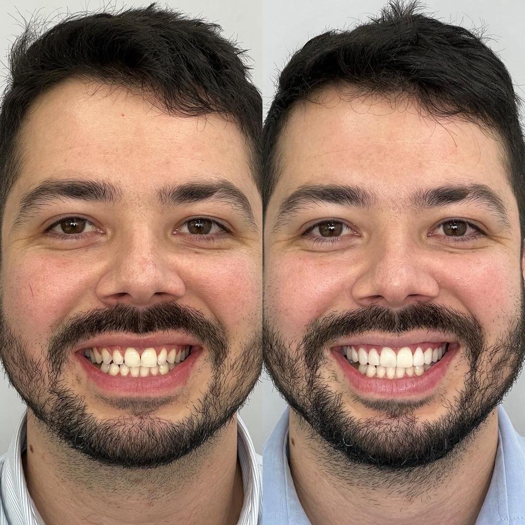 Antes X Depois 4