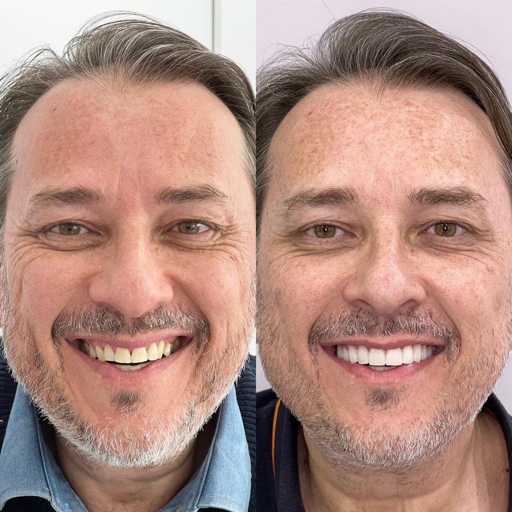 Antes X Depois 5