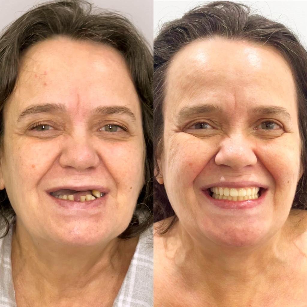 Antes X Depois 6