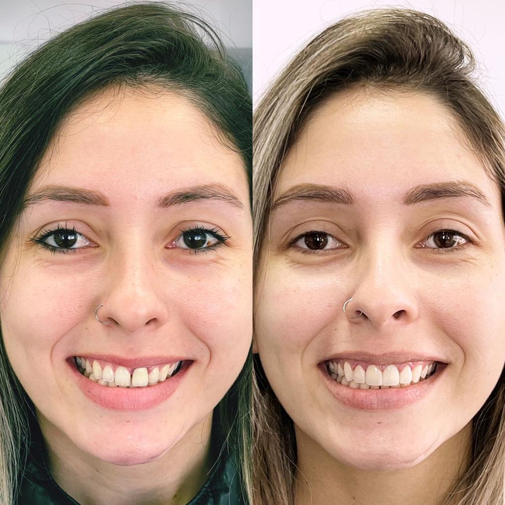 Antes X Depois 7
