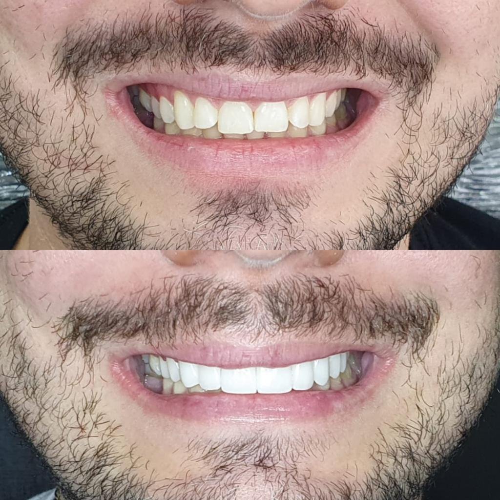 Antes X Depois